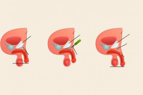 przed i po operacji powiększenia penisa